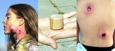 Verletzung durch Holzgeschosse (USA)